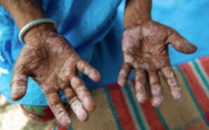 HIRVATİSTAN: NEPAL UYRUKLU BİR İŞÇİDE CÜZZAM HASTALIĞI TESPİT EDİLDİ